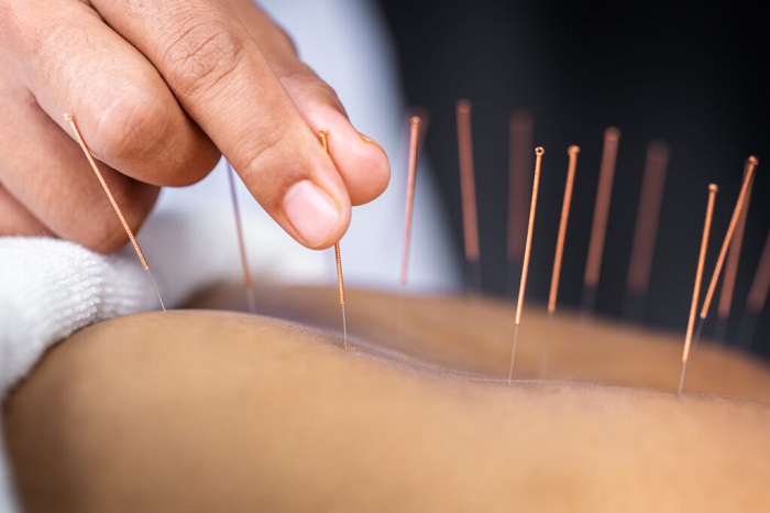 What Role Does Qi Flow Play in Traditional Acupuncture for&nbsp;Migraines